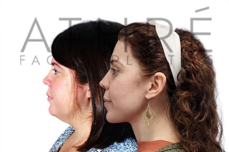 Before and after facial rejuvenation with blepharoplasty and deep neck lift by Dr. Raghu Athré.