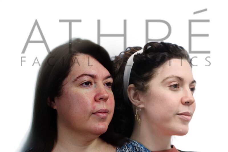 Female patient before and after blepharoplasty brow lift and deep plane facelift by Dr. Raghu Athré.