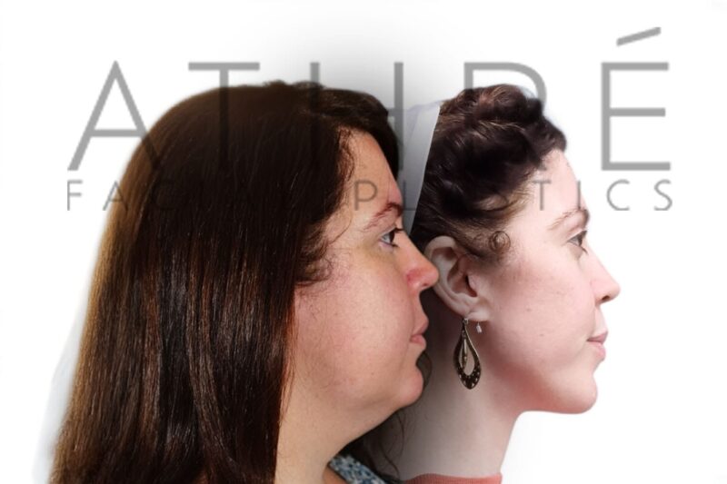 Before and after upper eyelid blepharoplasty and 4D Facelift by Dr. Raghu Athré. Side view.