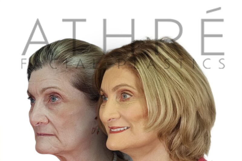 80 year old female before and after lower eyelid skin pinch blepharoplasty by Dr. Raghu Athré.