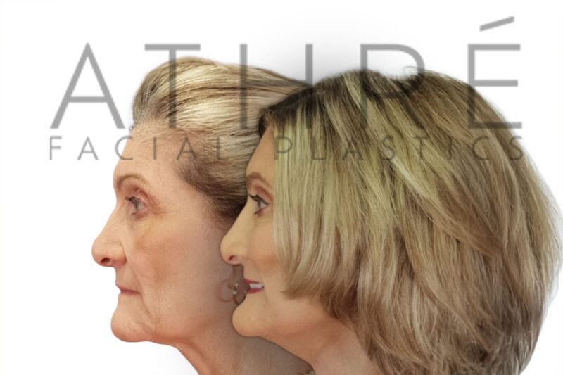 Before and after lower eyelid blepharoplasty with fat transfer by Dr. Raghu Athré.