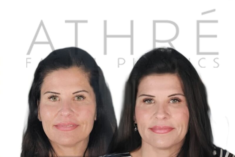 Before and after lower eyelid laser blepharoplasty by Dr. Raghu Athré.