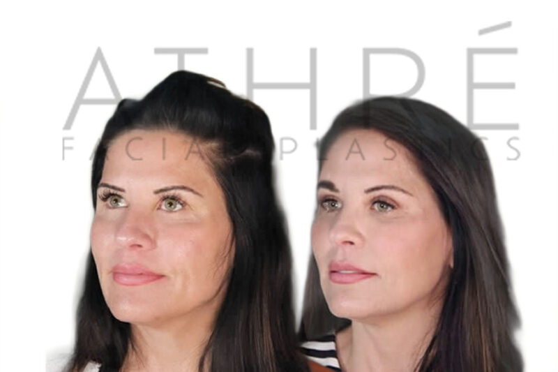 Before and after lower eyelid laser blepharoplasty by Dr. Raghu Athré.