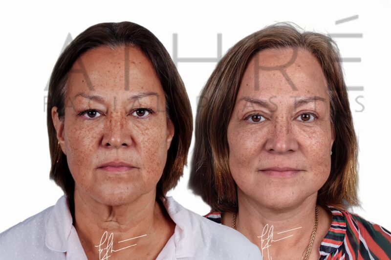 Before and after upper blepharoplasty and 4D Facelift by Dr. Raghu Athré.
