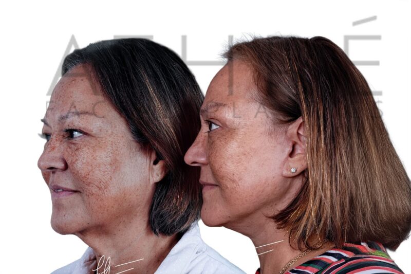 Before and after deep plane facelift and fat grafting by Dr. Raghu Athré.