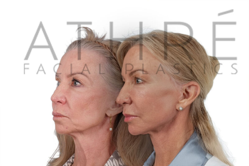 Female patient before and after revision facelift neck lift and blepharoplasty by Dr. Raghu Athré.