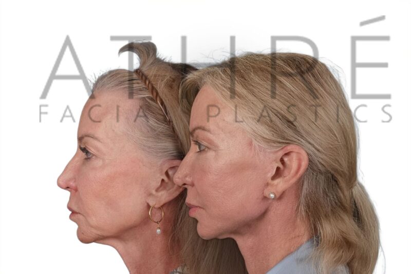 Before and after revision upper eyelid surgery and deep plane facelift by Dr. Raghu Athré.