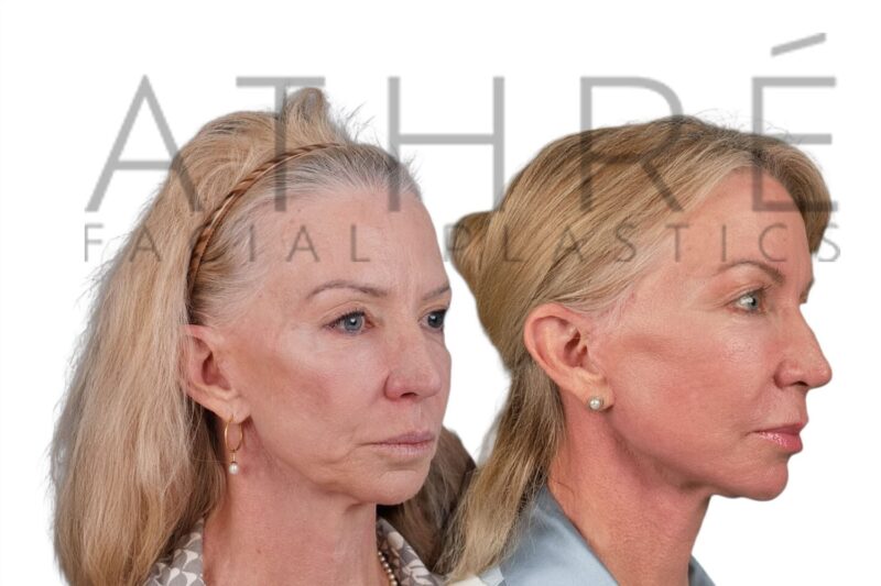 Before and after revision facial rejuvenation surgery by Dr. Raghu Athré.