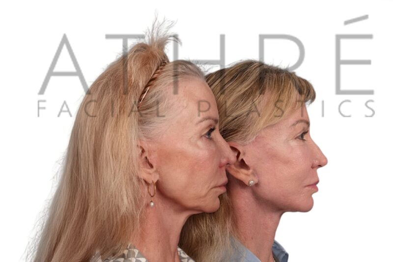 Female patient before and after revision 4D Facelift and upper blepharoplasty by Dr. Raghu Athré.