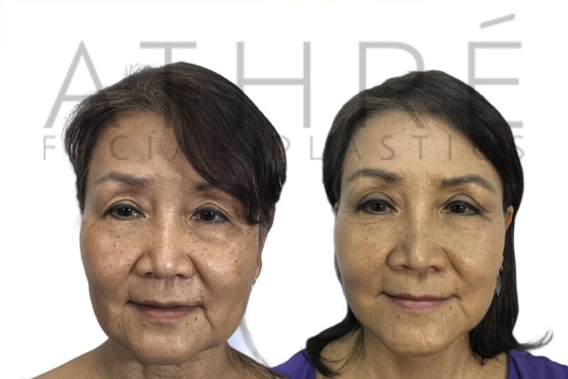Before and after upper blepharoplasty and SMAS facelift by Dr. Raghu Athré.