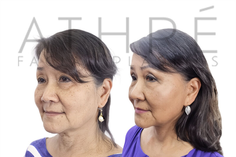 Before and after Asian facial rejuvenation with SMAS facelift by Dr. Raghu Athré.