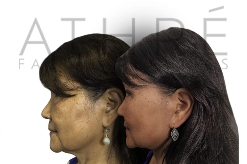 Asian female before and after upper blepharoplasty and neck lift by Dr. Raghu Athré.