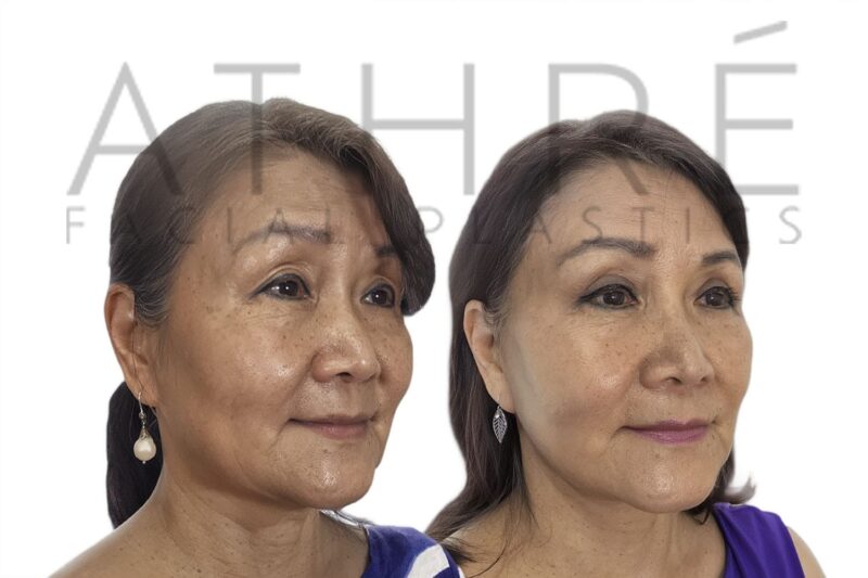Before and after Asian blepharoplasty and facelift by Dr. Raghu Athré.