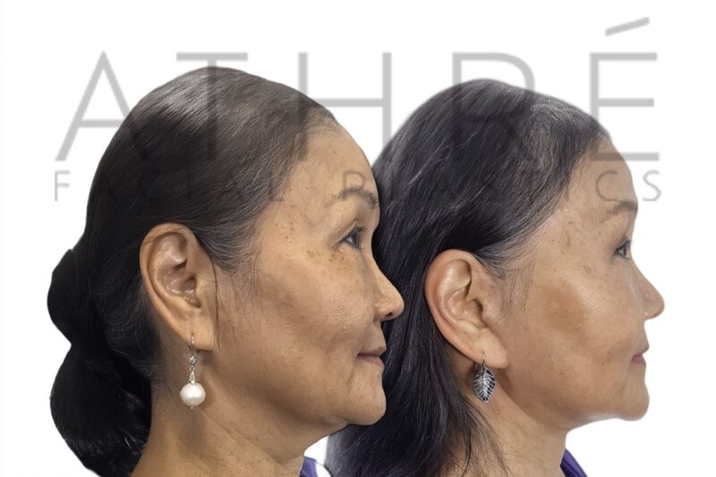 Before and after Asian upper blepharoplasty and deep neck lift by Dr. Raghu Athré.