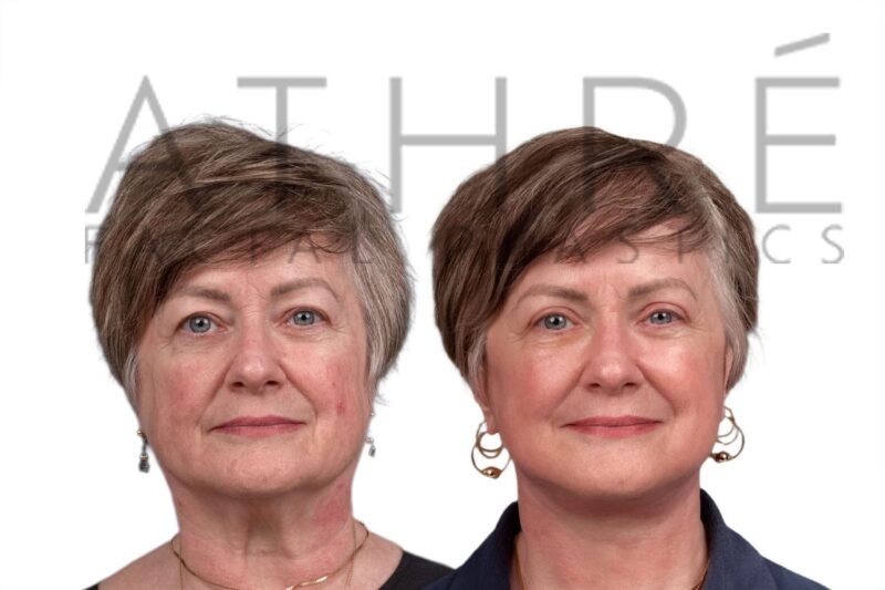 Female patient before and after deep plane facelift and blepharoplasty by Dr. Raghu Athré.