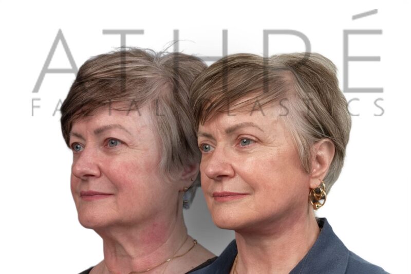 Before and after upper eyelid surgery and deep neck lift by Dr. Raghu Athré.