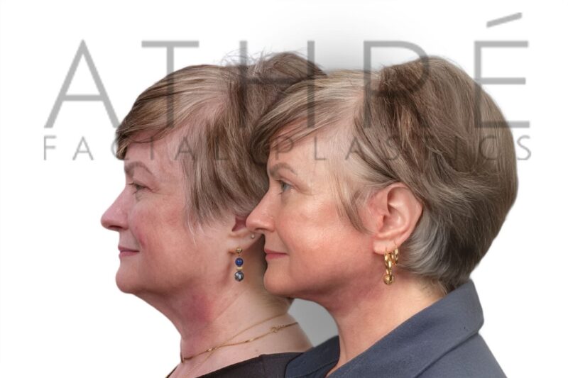 Before and after facial rejuvenation with chemical peel and facelift by Dr. Raghu Athré.