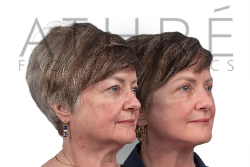 Female patient before and after facelift neck lift and blepharoplasty by Dr. Raghu Athré.