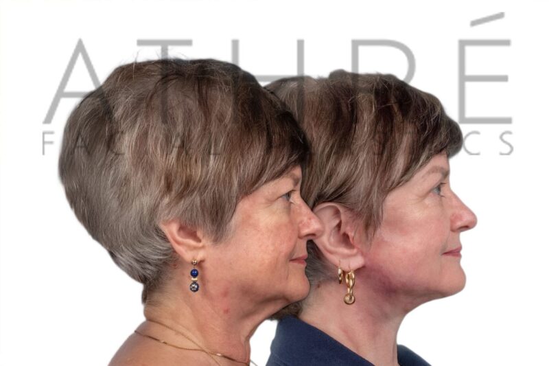 Before and after upper blepharoplasty and deep plane facelift by Dr. Raghu Athré.