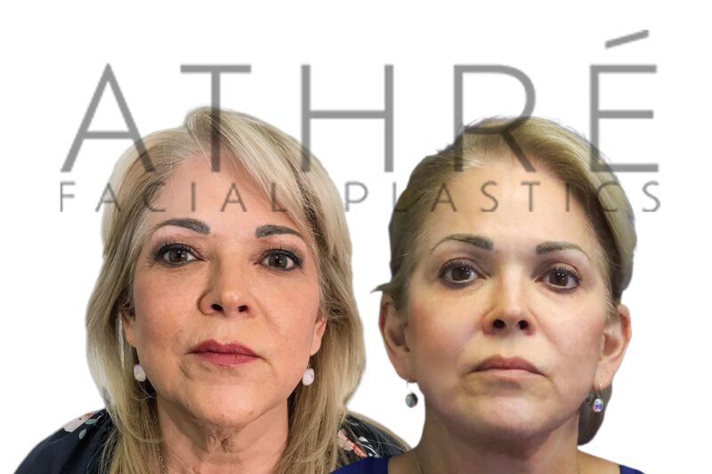 Before and after upper blepharoplasty and fat transfer by Dr. Raghu Athré.