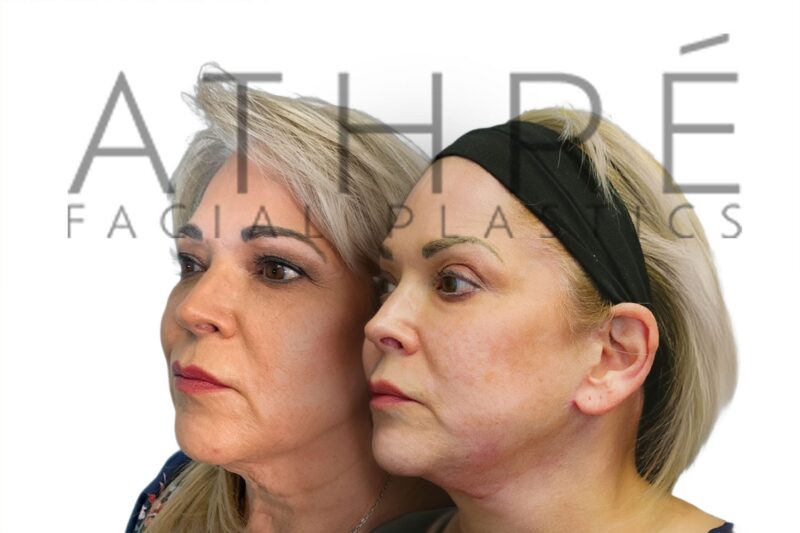 Female patient before and after upper eyelid surgery by Dr. Raghu Athré.