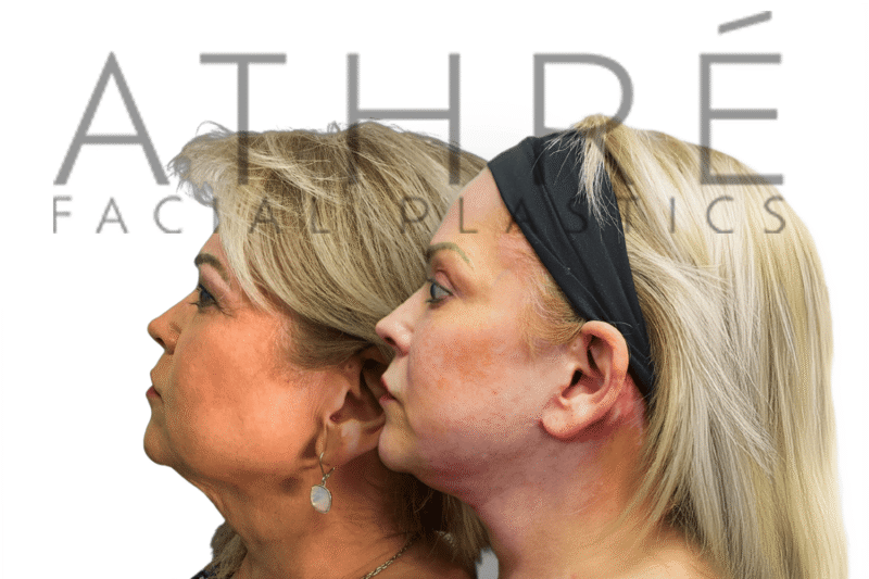 Before and after upper blepharoplasty and facial rejuvenation by Dr. Raghu Athré.