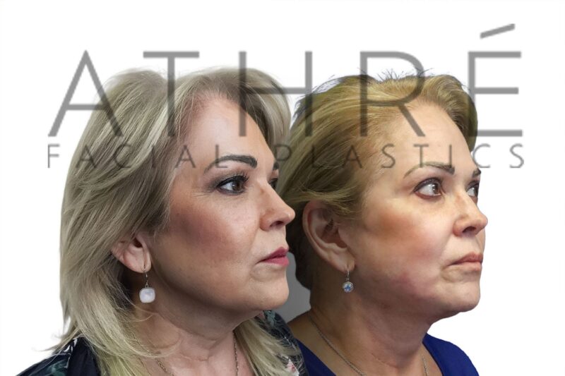 Before and after chemical peel and upper eyelid surgery by Dr. Raghu Athré.