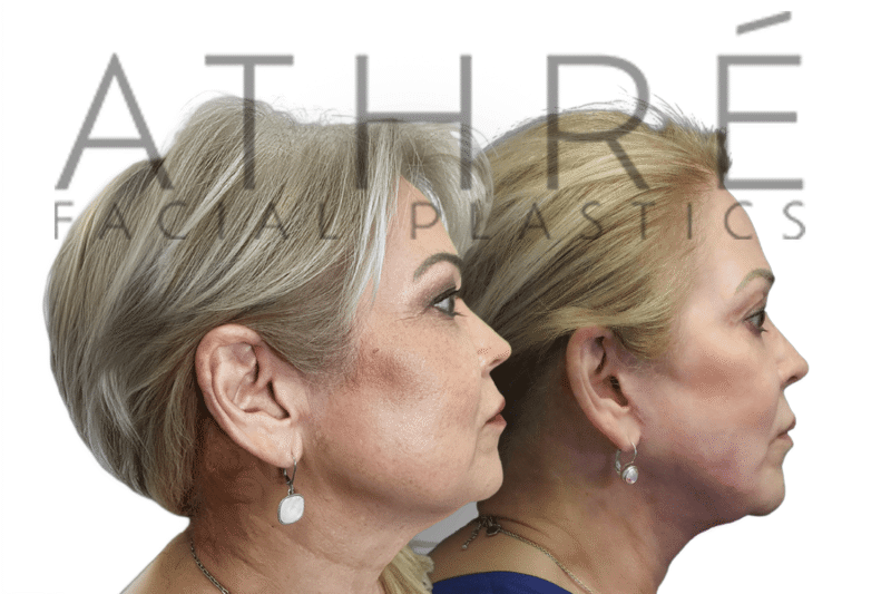 Female before and after upper blepharoplasty and chemical peel by Dr. Raghu Athré.