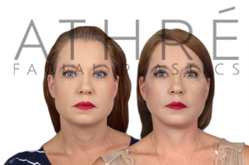 Before and after deep plane facelift and upper blepharoplasty by Dr. Raghu Athré.