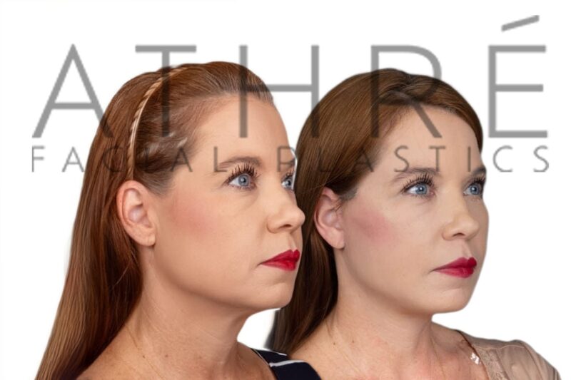 Female patient before and after facelift and upper eyelid surgery by Dr. Raghu Athré.