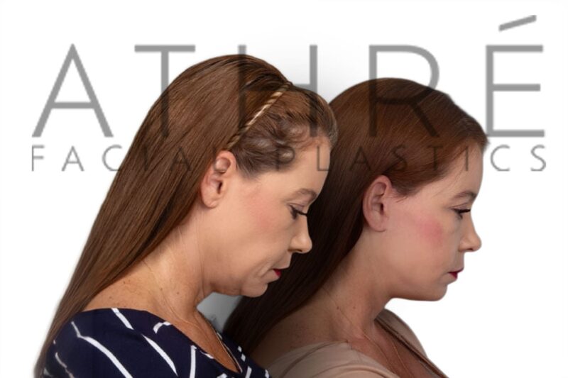 Before and after facial rejuvenation with deep plane facelift by Dr. Raghu Athré.