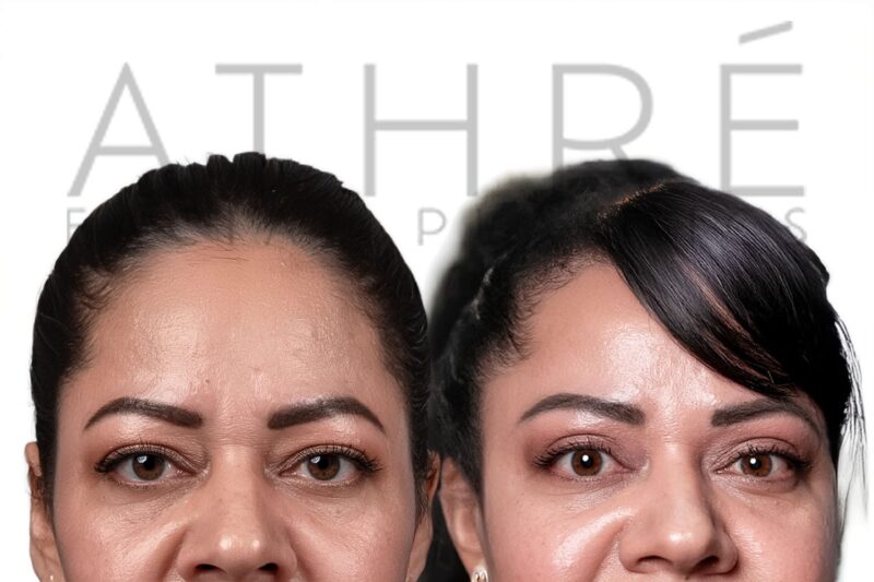 Female patient before and after upper eyelid surgery by Dr. Raghu Athré