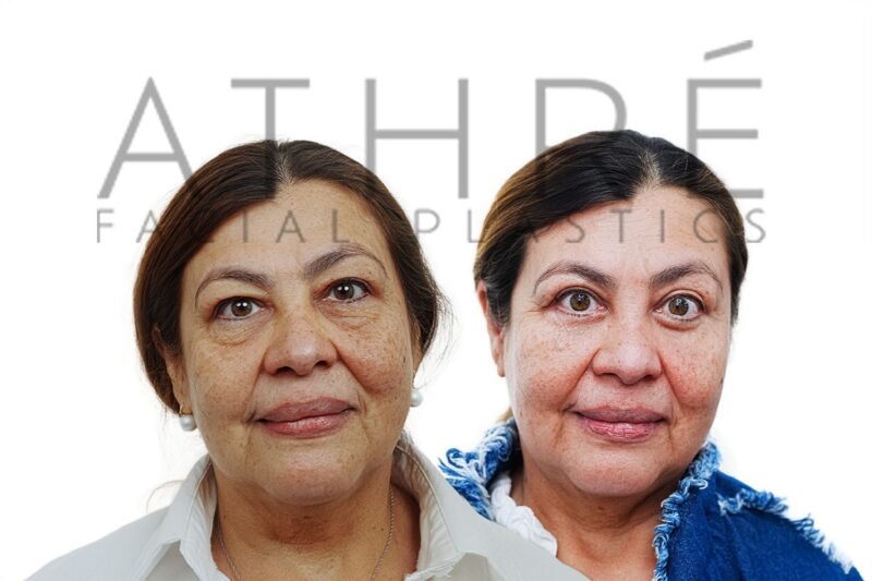 Before and after upper and lower blepharoplasty with canthopexy by Dr. Raghu Athré