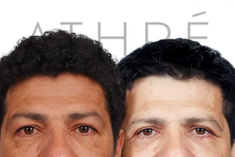 Before and after male upper blepharoplasty by Dr. Raghu Athré