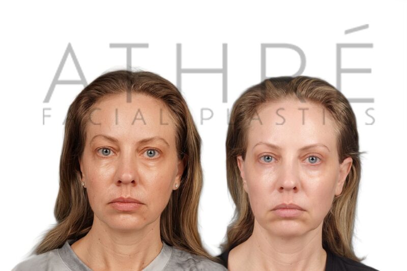 Female patient before and after upper eyelid surgery by Dr. Raghu Athré.