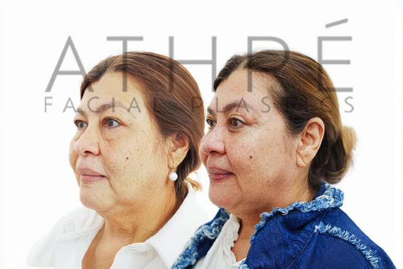 Female patient before and after blepharoplasty and canthopexy by Dr. Raghu Athré.