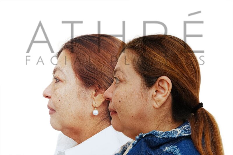 Before and after eyelid rejuvenation with canthopexy by Dr. Raghu Athré.