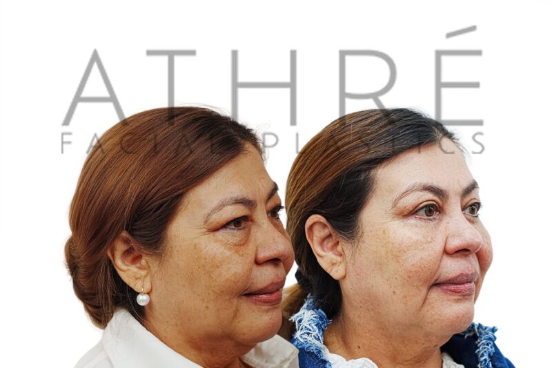 Before and after upper lower eyelid surgery by Dr. Raghu Athré.