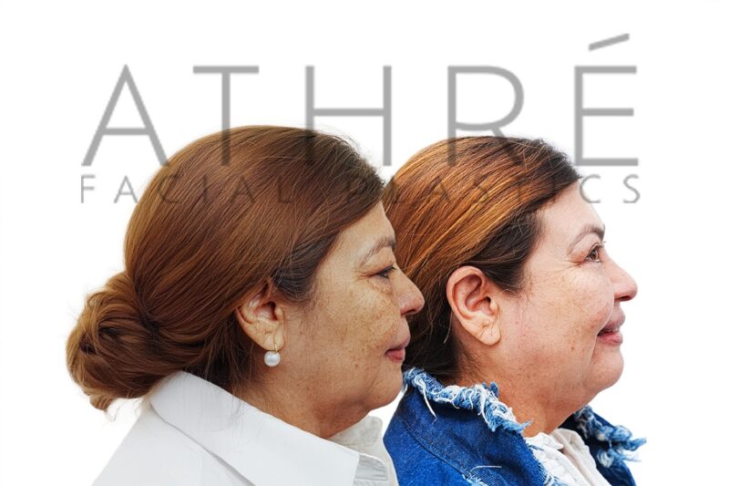 Female before and after blepharoplasty with lower eyelid support by Dr. Raghu Athré.