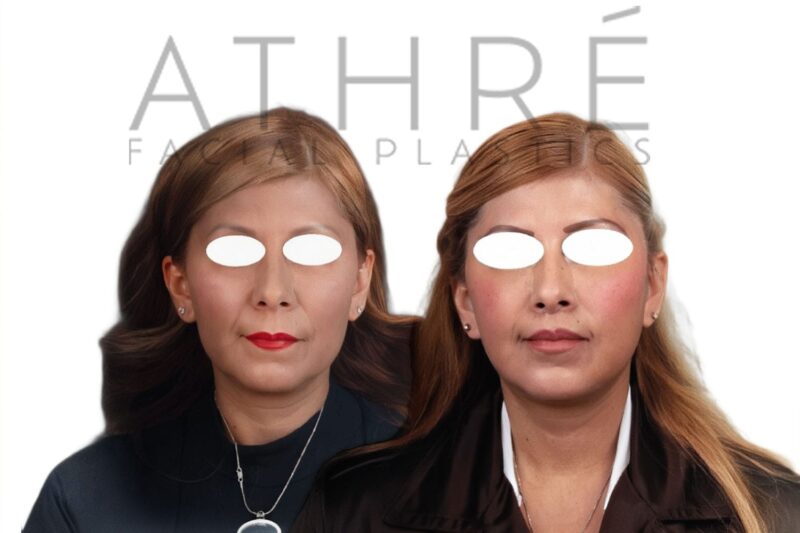 Before and after deep plane facelift and lip lift by Dr. Raghu Athré in 51-year-old female patient.