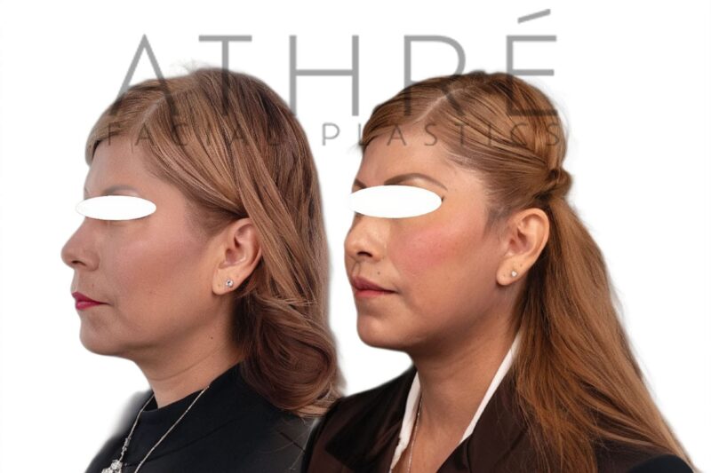 Female patient after deep neck lift and facial fat transfer by Dr. Raghu Athré.