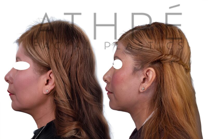Before and after facial rejuvenation with facelift and stem cell nanofat treatment by Dr. Raghu Athré.