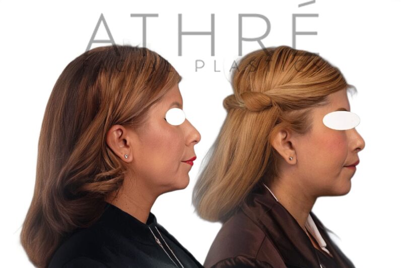 Facial rejuvenation surgery including facelift and autologous fat transfer performed by Dr. Raghu Athré.