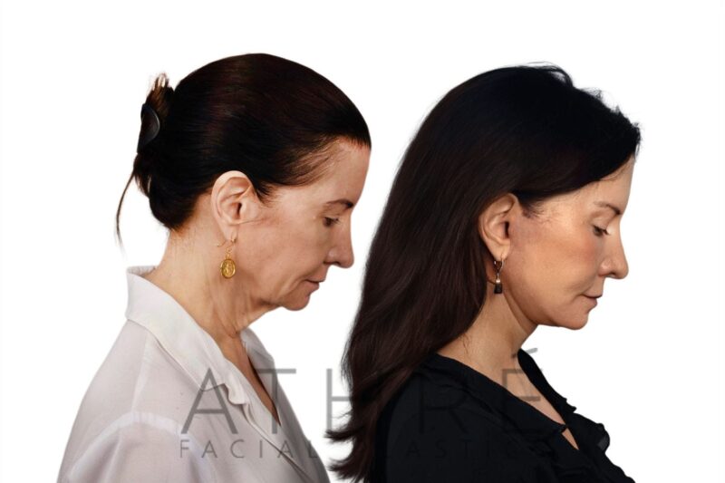 Before and after deep plane facelift, brow lift, and upper blepharoplasty by Dr. Raghu Athré in female patient.