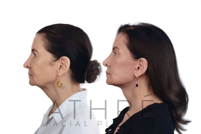 Female patient shown after brow lift and stem cell nanofat treatment performed by Dr. Raghu Athré.