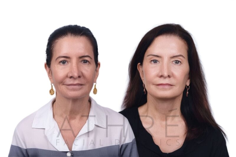 Female patient after 4D Facelift™, deep neck lift, and facial fat transfer by Dr. Raghu Athré.