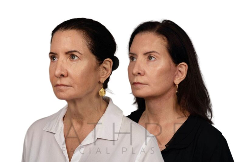 Before and after facial rejuvenation with facelift and chemical peel by Dr. Raghu Athré.