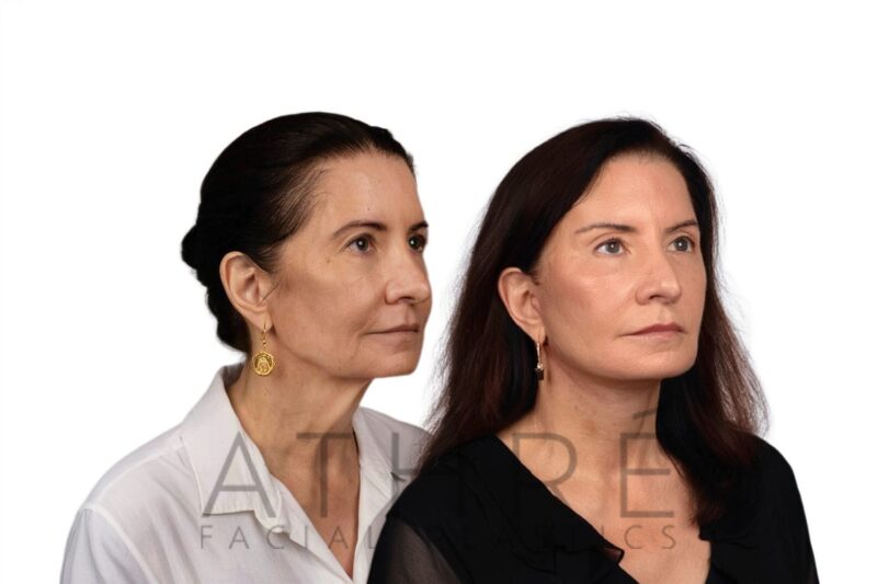 Facial rejuvenation surgery including facelift and upper eyelid surgery performed by Dr. Raghu Athré.