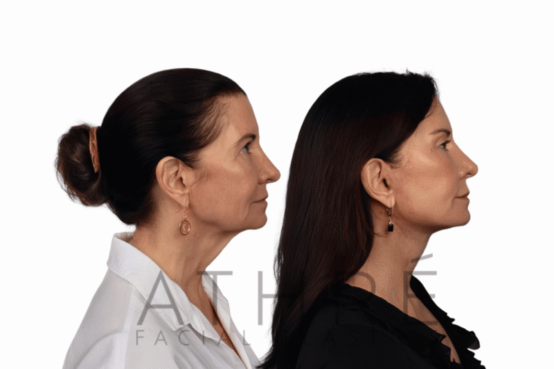 Before and after 4D Facelift™, brow lift, upper blepharoplasty, and chemical peel by Dr. Raghu Athré in female patient.