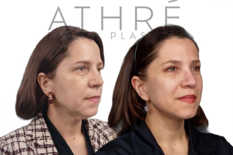 Before and after deep plane facelift and lower blepharoplasty by Dr. Raghu Athré in female patient.